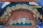 Step2.歯ぐきの保護・薬剤塗布